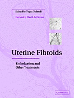Uterine Fibroids - ISBN 9780521819381