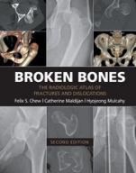Broken Bones - ISBN 9781107499232
