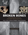Broken Bones - ISBN 9781107499232