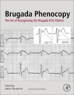 Brugada Phenocopy: The Art of Recognizing the Brugada ECG Pattern - ISBN 9780128111512