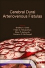 Cerebral Dural Arteriovenous Fistulas - ISBN 9780128195253