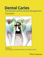 Dental Caries: The Disease and its Clinical Management - ISBN 9781118935828