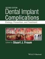 Dental Implant Complications: Etiology, Prevention, and Treatment - ISBN 9781118976456