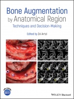 Bone Augmentation by Anatomical Region: Techniques and Decision–Making - ISBN 9781119427841